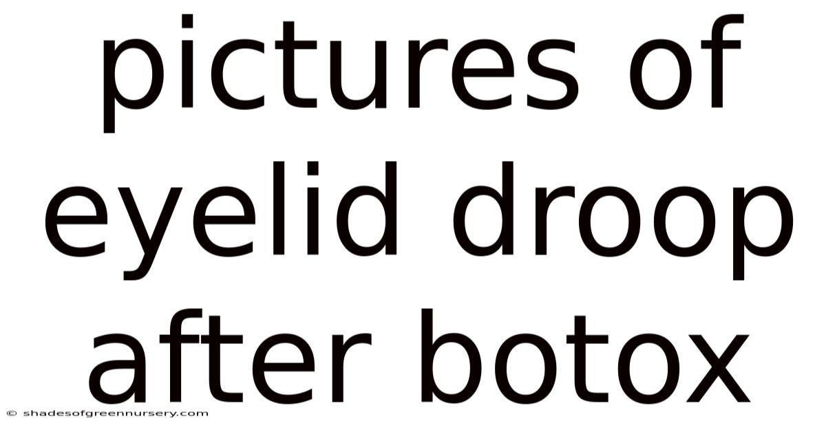 Pictures Of Eyelid Droop After Botox